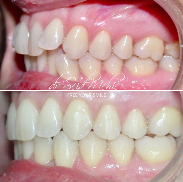 Invisalign proteze